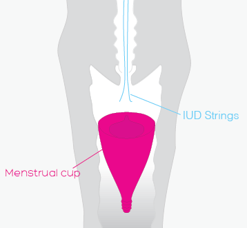 article-usingcupwithIUD_Menstrualcup_diagrams_zoom