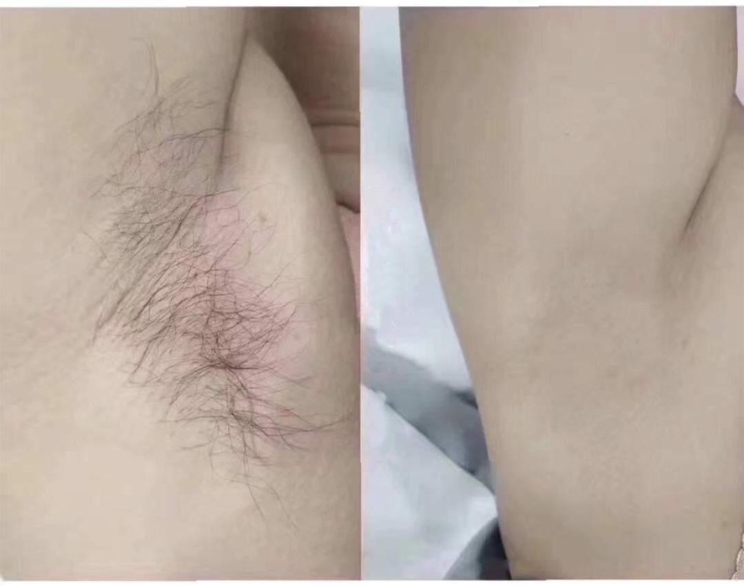 Results of Laser Hair Removal For Underarms