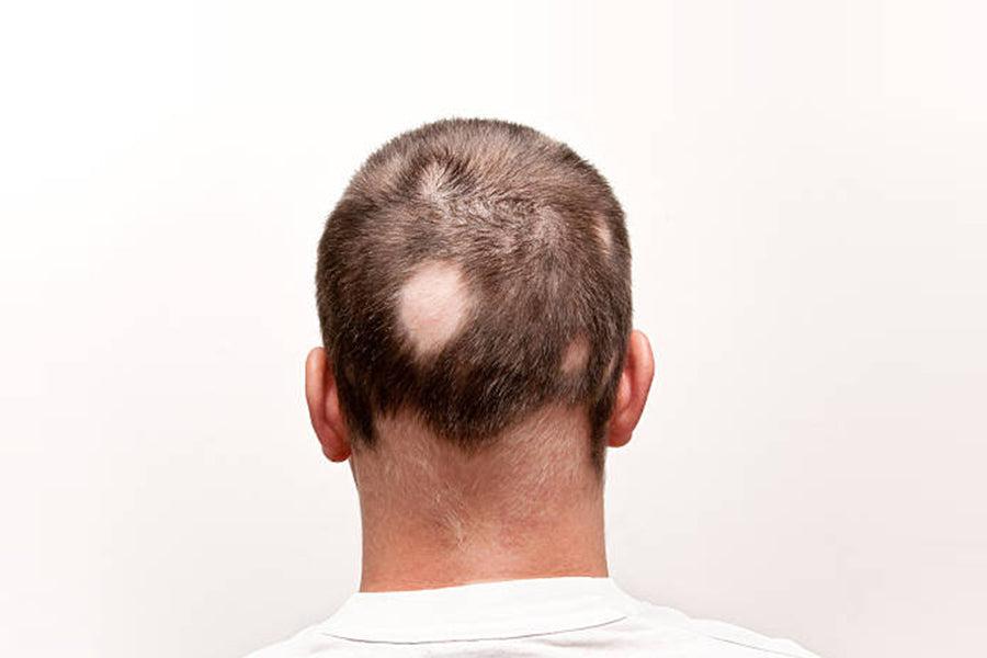 Alopecia Areata – Causes, Symptoms & Natural Remedies – Traya