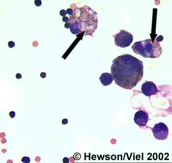 BAL cytology showing erythrocytophagia (arrows). Wright-Giemsa stain. Magnification: 1000X.