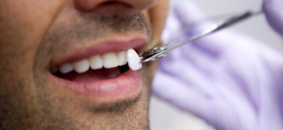 Dental Veneers Treatments For a Beautiful Smile