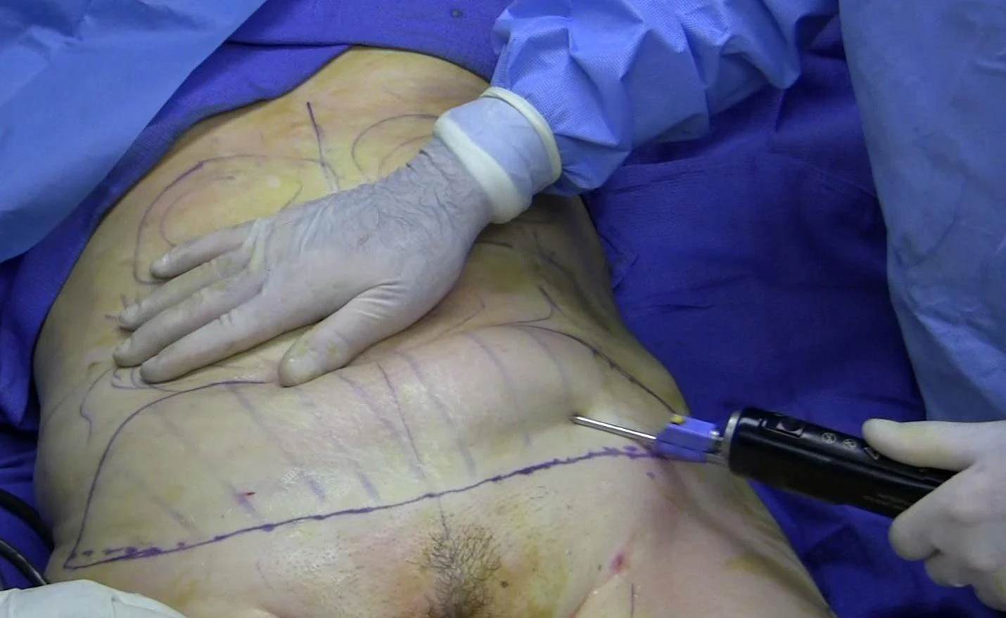 Liposuction - Wikipedia
