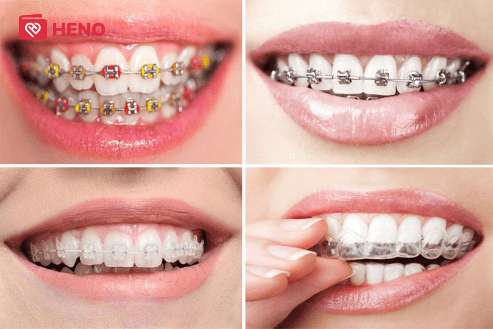 niềng răng tốn bao nhiêu tiền còn phụ thuộc vào phương pháp niềng răng
