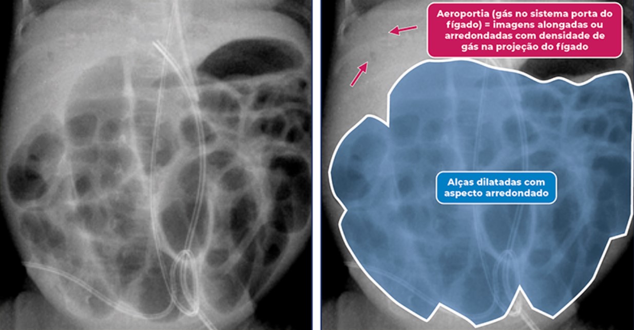 Uma imagem ilustrativa atrelada à enterocolite necrotizante! Confira!