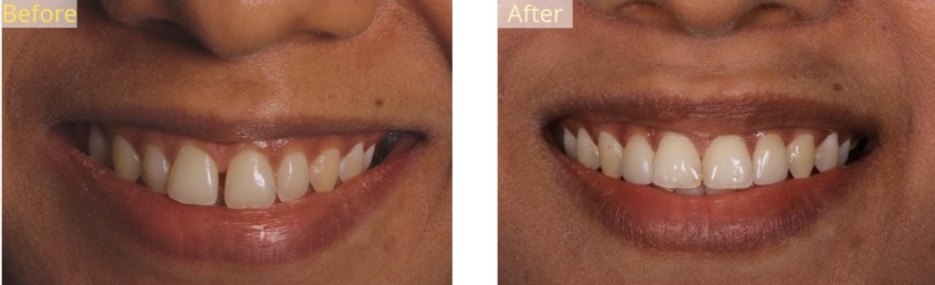 composite veneers