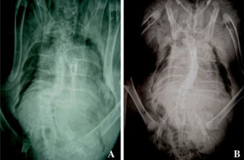 X-ray showing short, angular curve with severe wedging at the apex with partial dislocation of a bone in a joint (subluxation) of one vertebra on another. X-ray indicative of scoliosis and osteomyelosclerosis.