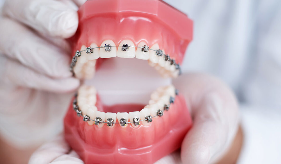 Teeth Alignment Braces