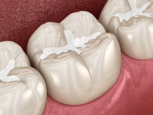 Dental Fillings - What You Should Know Before You Get One | FSD2