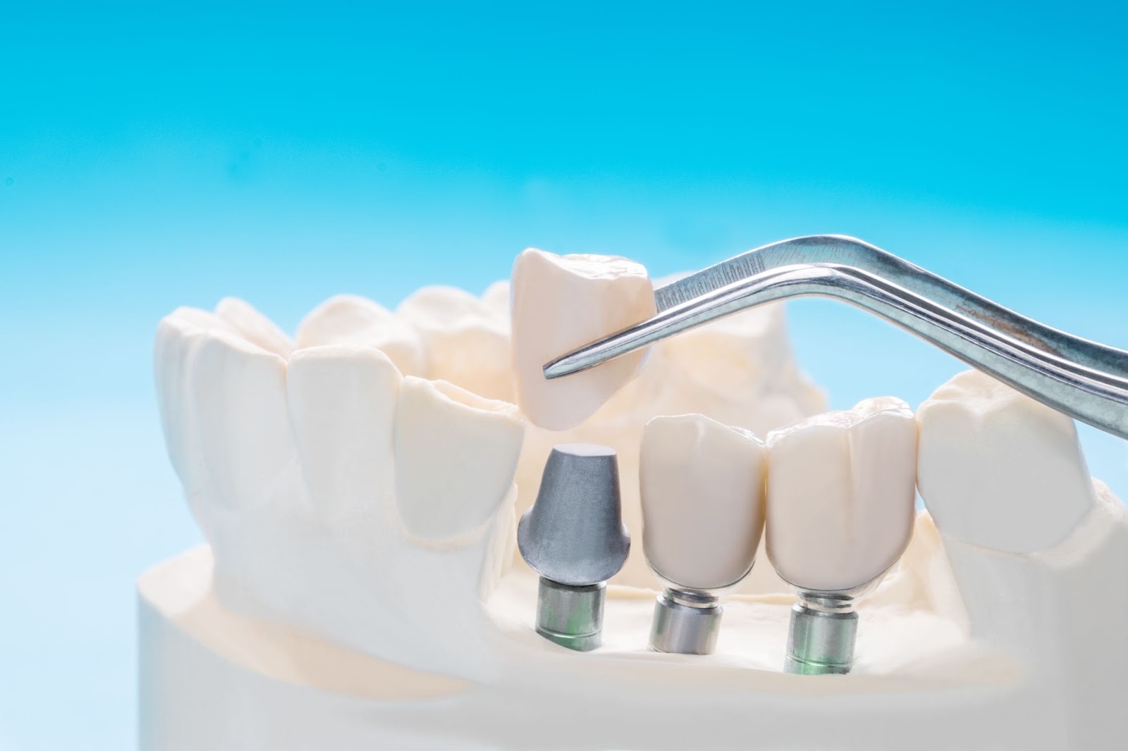 Impianti dentali che sostituiscono un'intera arcata di denti mancanti