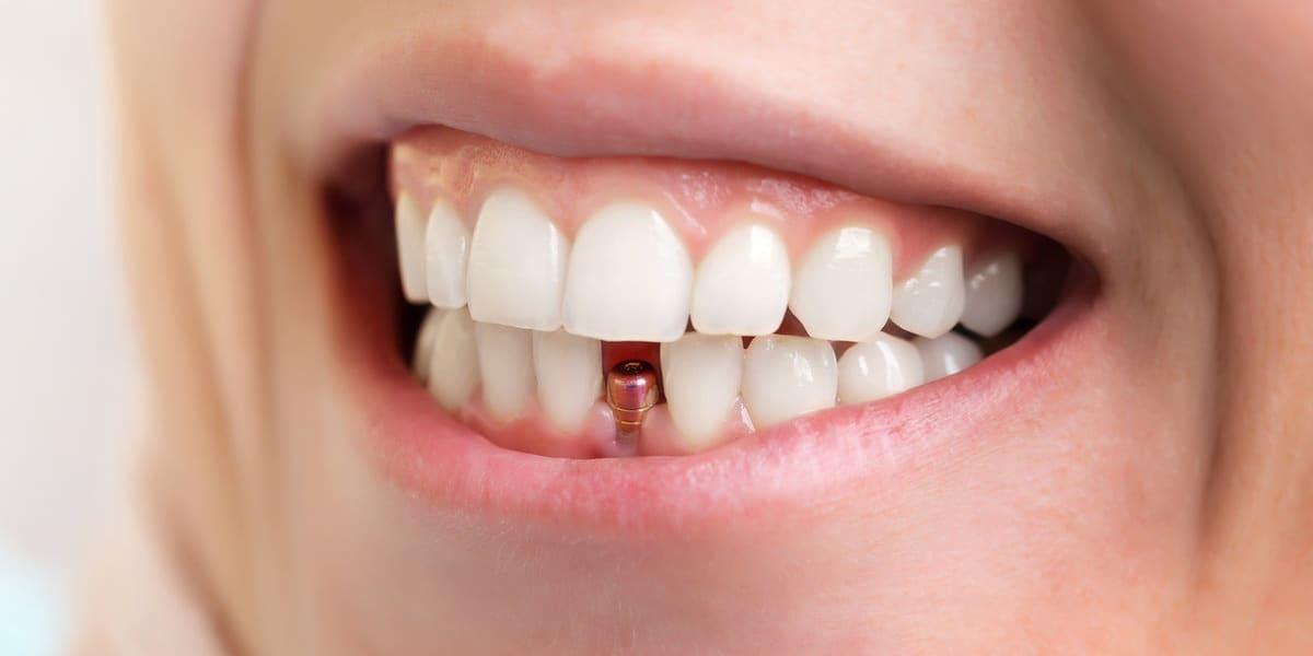 Image result for Dental Implants
