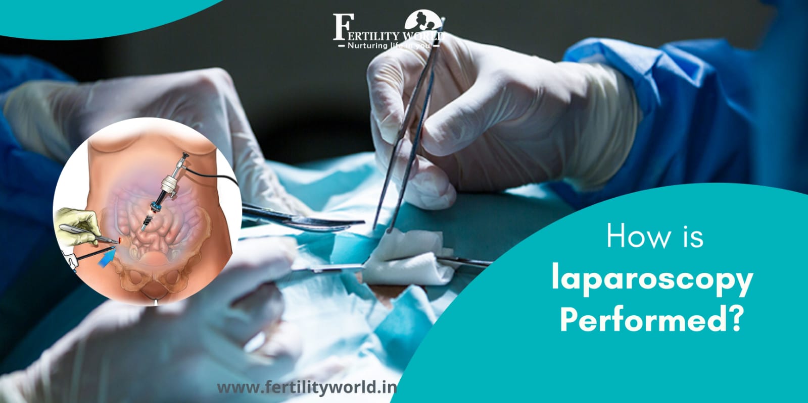 How is laparoscopy performed?