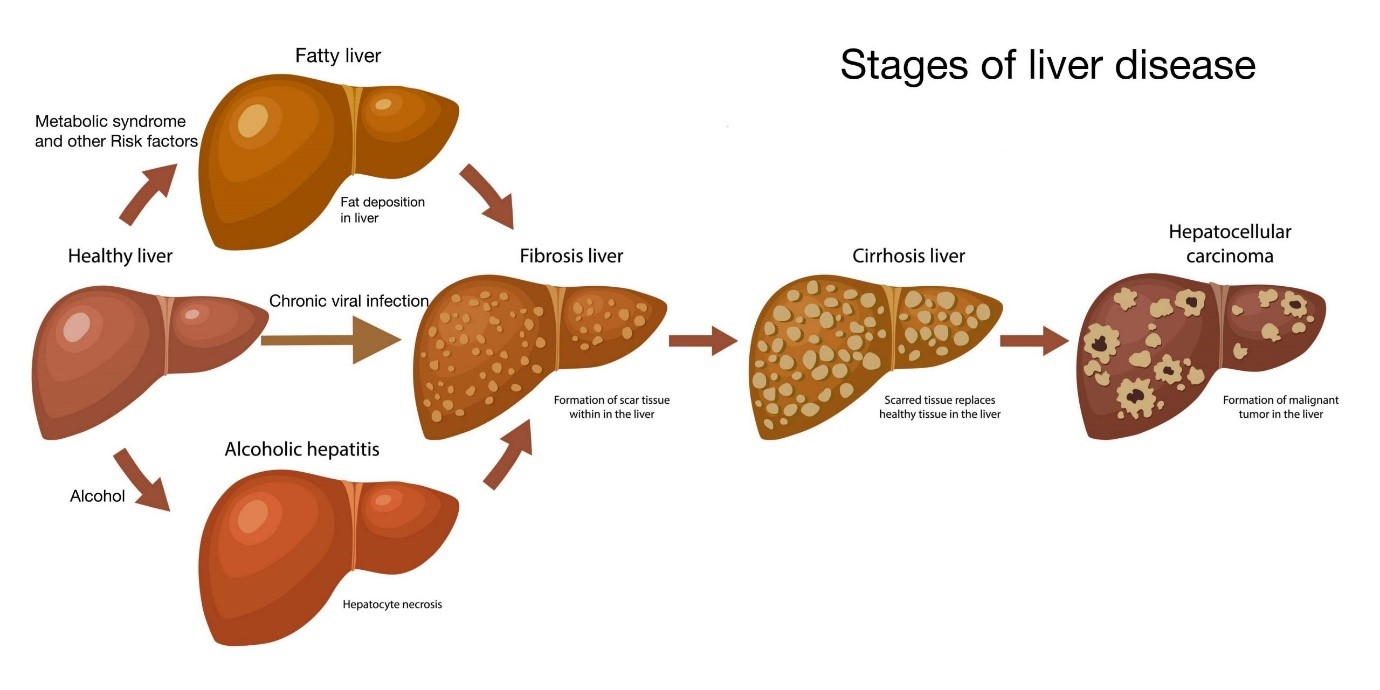 Liver Cirrhosis: What, Symptoms, Why, Treatment, Diagnosis