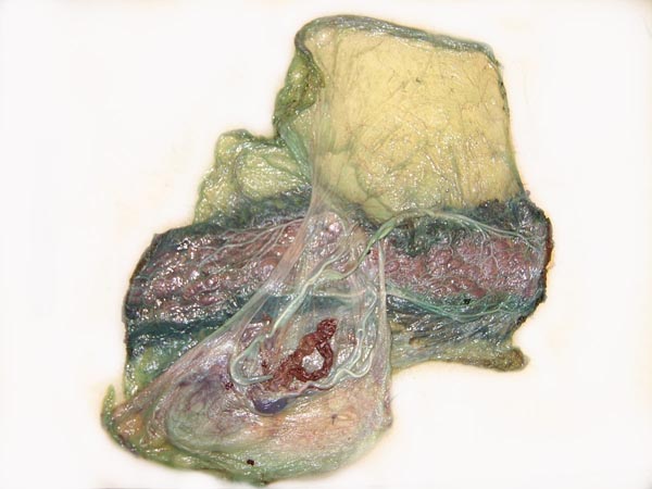 Fetal aspect of dog placenta. Note the hematoma and its green coloration, especially after fixation