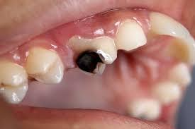 rotting tooth