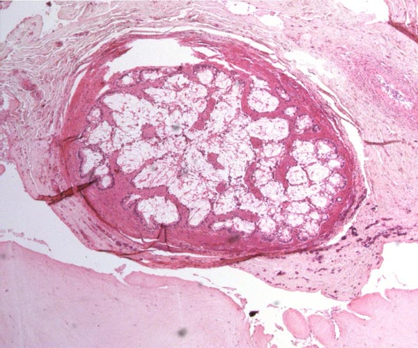 Small yolk-sac-like structure in placental surface
