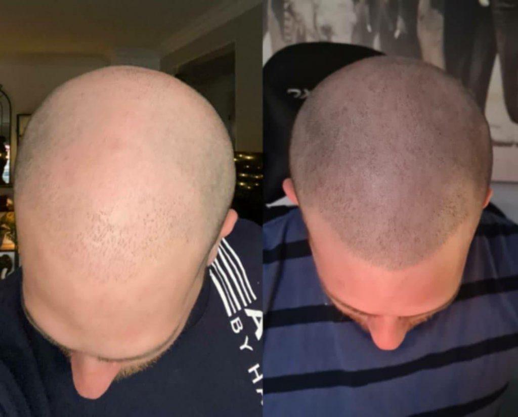 C:\Users\De Vine\Downloads\Before_and_after_scalp_micropigmentation.jpg