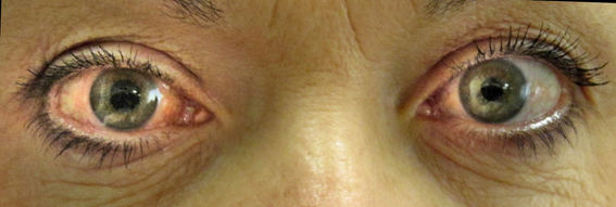 imagem ilustrativa de glaucoma