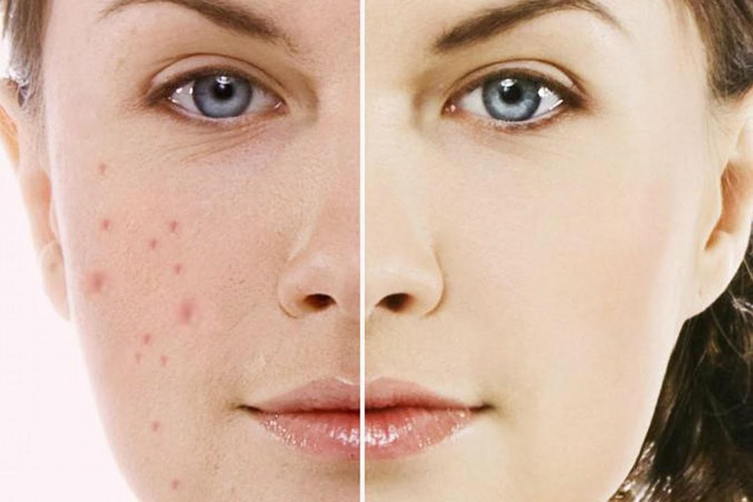 Kết quả hình ảnh cho Trị vết thâm sau mụn bằng laser