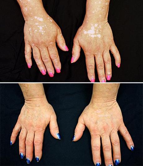 vitiligo_Yale-Uni-Before-and-After.jpg