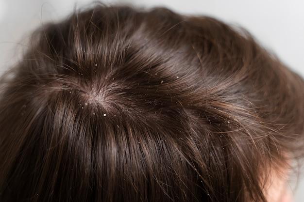 Couro cabeludo de uma mulher com calvície feminina e caspas