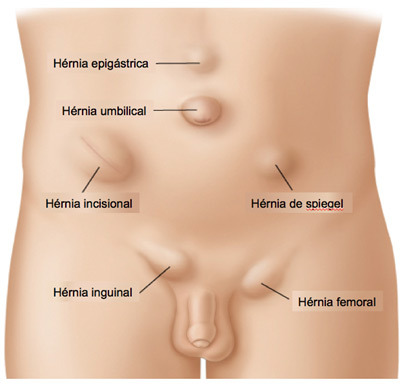 Hérnias abdominais externas