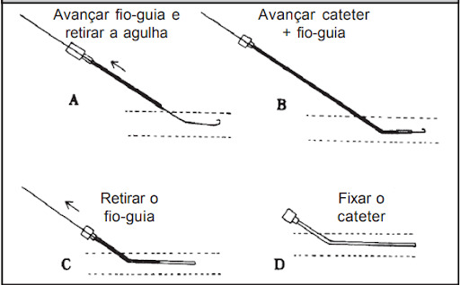 Figura 2: Técnica de punção vascular percutânea com técnica de Seldinger (fio-guia). (A) puncionar o vaso, introduzir o fio-guia e retirar a agulha; (B) avançar o cateter vestindo o fio-guia para dentro do vaso; (C) retirar o fio-guia; (D) fixar o cateter em posição. 