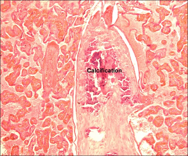 Foci of calcification are common in late pregnancy