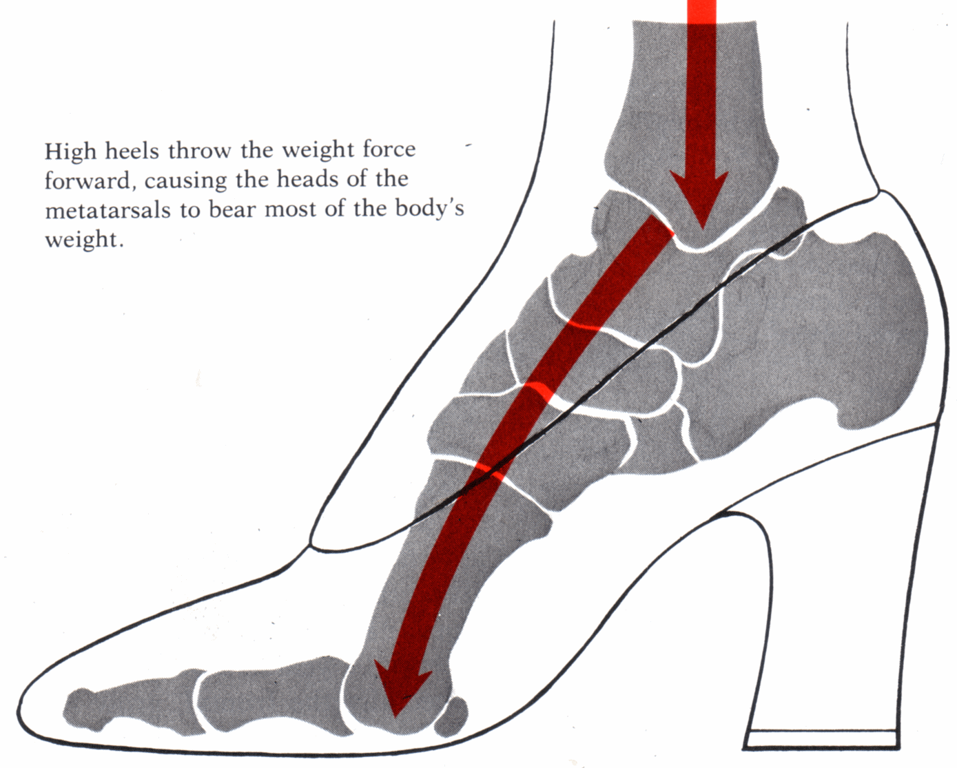 Image result for metatarsalgia high heels
