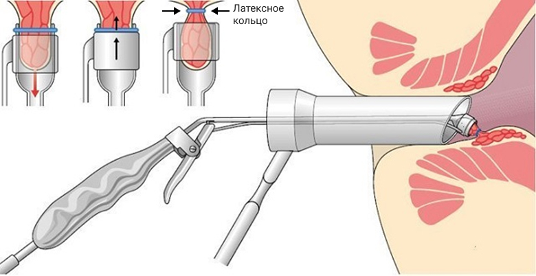 Схема латексного лигирования геморроидального узла в лечении геморроя 