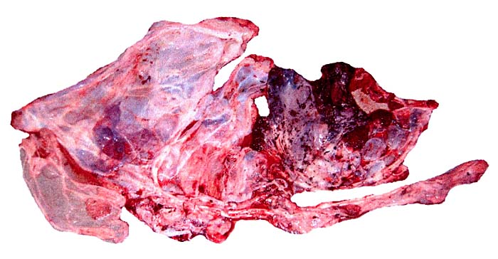New placenta from the fetal demise
