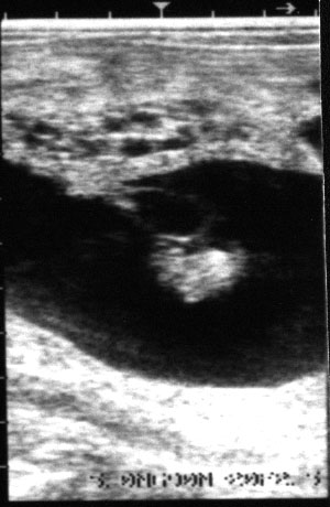 Ultrasonographic images of the left uterine horn of pregnant camels. Day 40, note the size of the foetus and volume of foetal fluids have increased considerably between days 30 and 40 and the yolk stalk is seen emerging from the foetus.