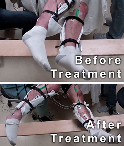 Image showing legs before and after treatment