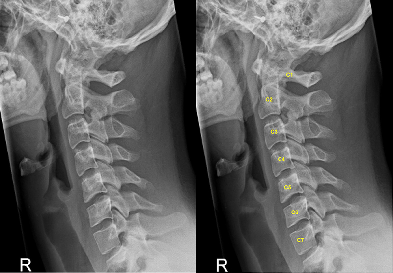 Hình ảnh X - quang của bệnh nhân bị thoái hóa cột sống cổ
