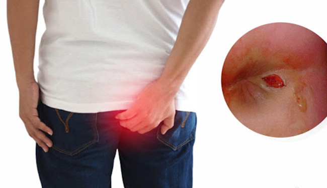 biểu hiện của bệnh trĩ