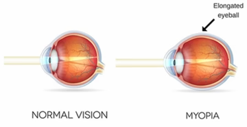 normal vision vs. myopia