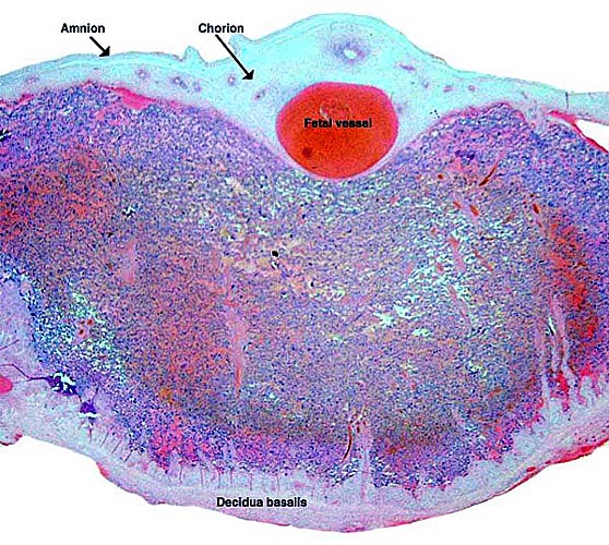 Low-power microscopic appearance of a section of this delivered placenta