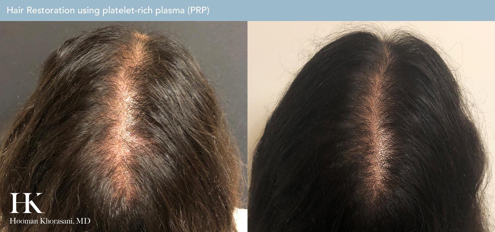 Hair Restoration Before and After Case