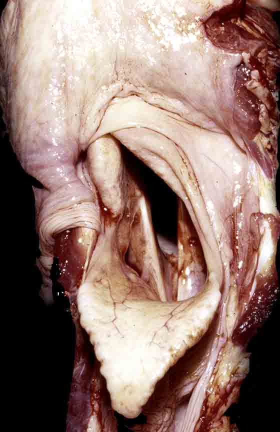Laryngeal asymmetry associated with unilateral hemiplegia.