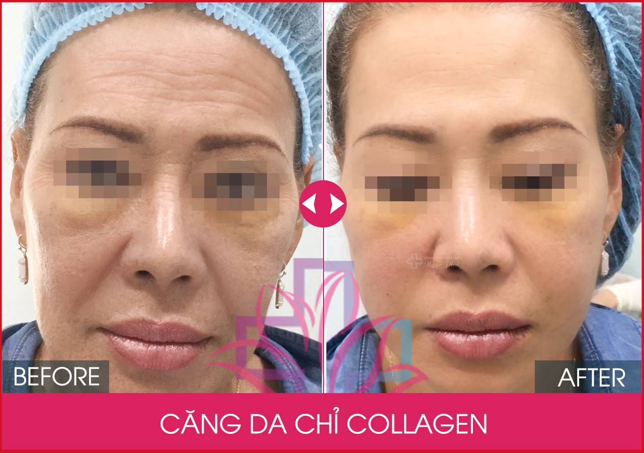 Căng da mặt bằng chỉ collagen là phương pháp giúp các chị em lấy lại tuổi xuân trong vòng từ 30 - 60 phút.