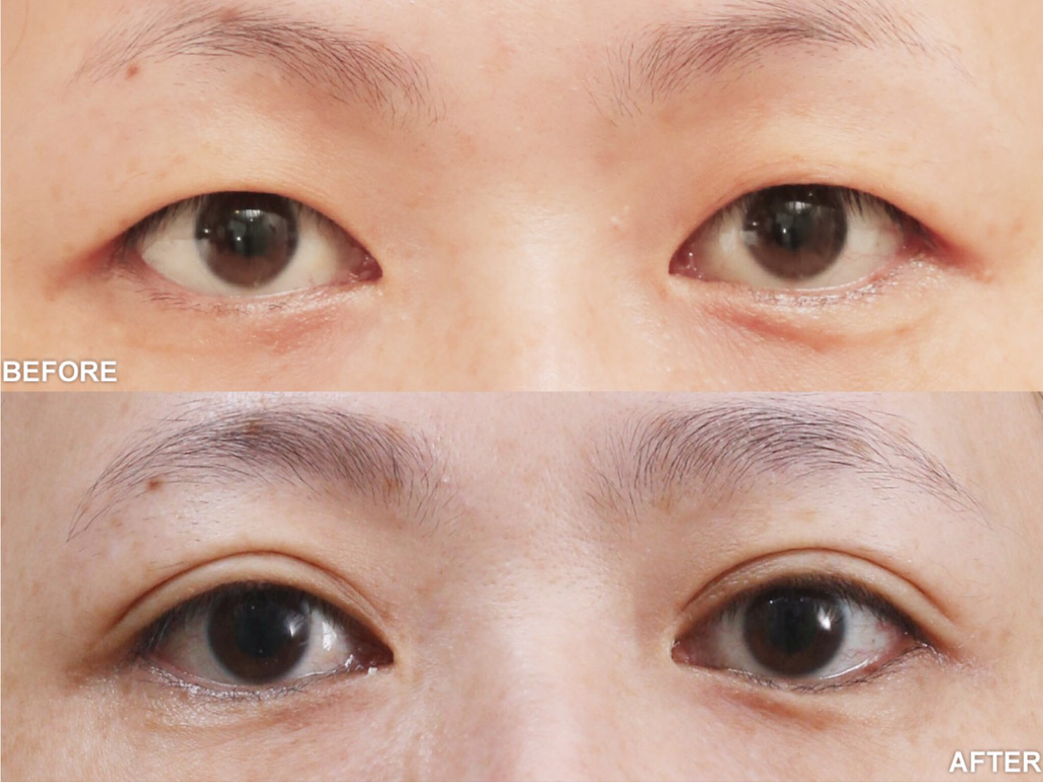 雙眼皮手術術前術後