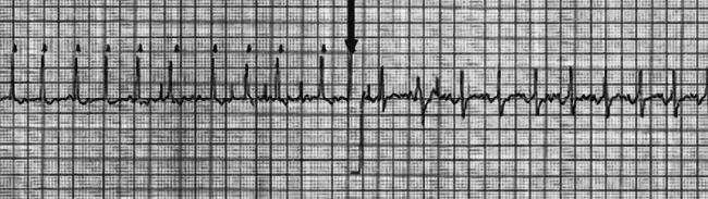 An ECG rhythm strip recorded during direct current (DC) cardioversion of atrial fibrillation in a dog with laryngeal paralysis