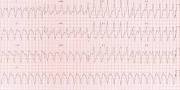 Image result for arrhythmia ecg examples