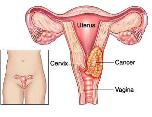 http://cancer-treatment-madurai.com/types-of-cancer-cervical-cancer.php