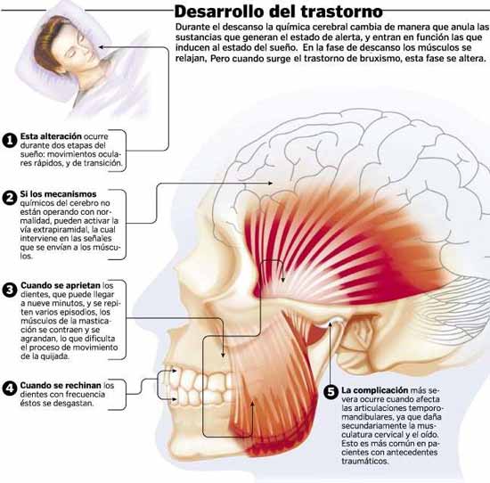 tratamiento-bruxismo-botox-odontologia-madrid-guadalajara.jpg