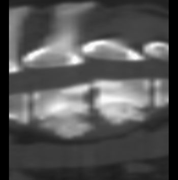 Sagittal, bone window CT image of a dog with thoracolumbar discospondylitis