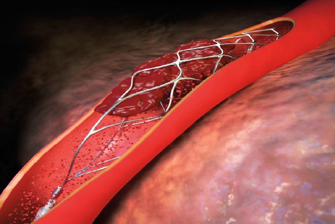 Khi nào cần đặt stent mạch vành, đặt rồi có khỏi bệnh không?