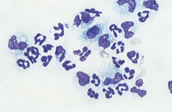 Abdominal fluid. Mixture of neutrophils and macrophages are present. Phagocytosed bacteria are noted. These findings confirm septic peritonitis (100x).