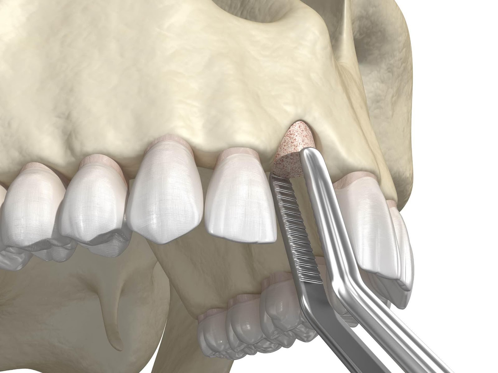 teeth implant in Vancouver 