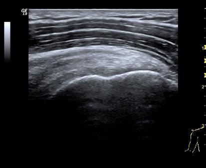 supraspinatus longitudinal