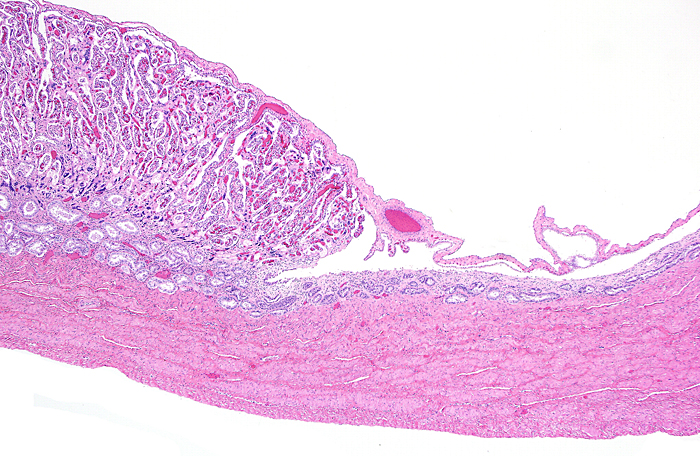 Another view of the margin of one of the placental ‘strips’ with view of underlying and adjacent endometrium.